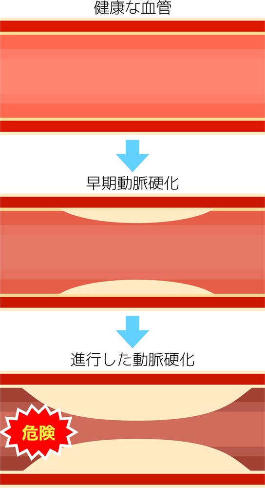 フロー図：健康な血管→早期動脈硬化→進行した動脈硬化（危険）